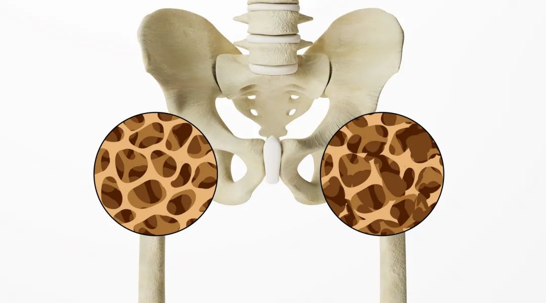  “預防骨質疏松，減少疼痛，遠離骨折”——東方總院内分泌科、疼痛科、骨科聯合舉辦大型義診